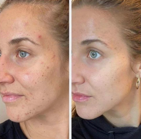 🔥ADIOS MANCHAS OSCURAS ⭐⭐⭐⭐⭐ NUEVO SUERO CORRECTOR DE MANCHAS OSCURAS